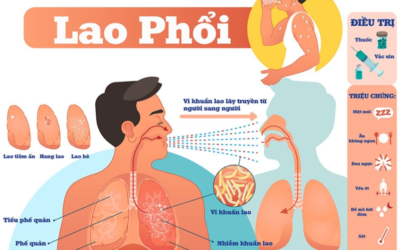 LÂY TRUYỀN BỆNH LAO