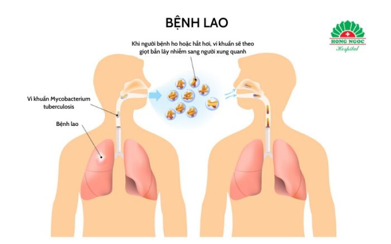 HỎI ĐÁP VỀ BỆNH LAO
