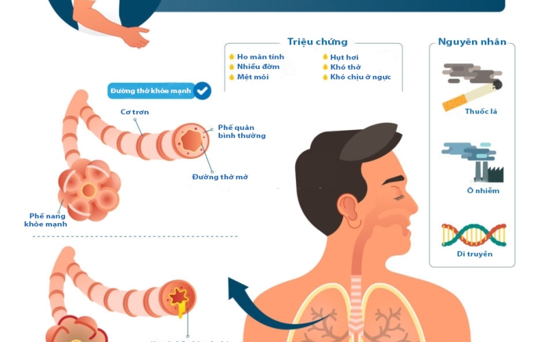 NHỮNG DẤU HIỆU CẢNH BÁO VÀ CÁCH XỬ TRÍ CÁC ĐỢT CẤP BỆNH PHỔI TẮC NGHẼN MẠN TÍNH
