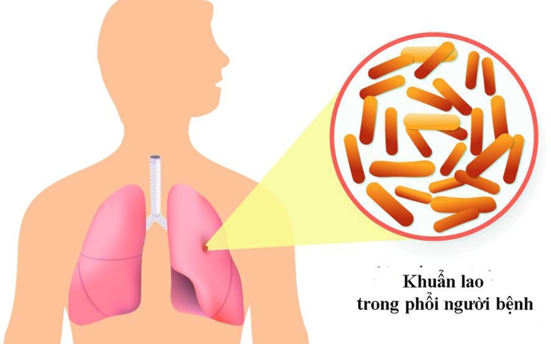PHÁT HIỆN BỆNH LAO  